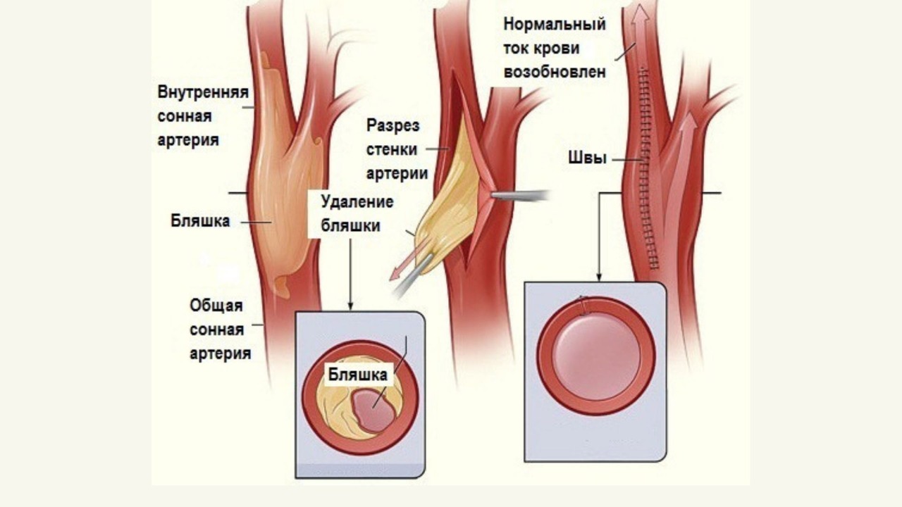 Удаление холестериновых бляшек